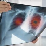 akciger kanseri gec fark ediliyor hastalarin yuzde 60inda kanser ileri evrede tespit ediliyor wkgabtsL.jpg