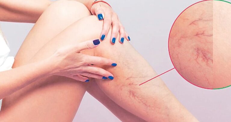 varis vucutta pihti riskini artirabilir mwsbnW3w.jpg